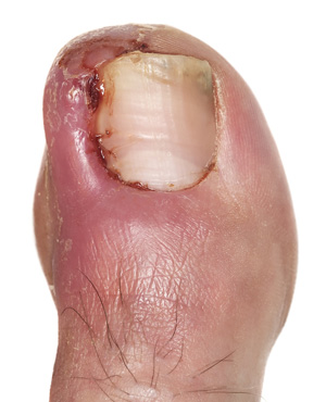 in-growing toenail