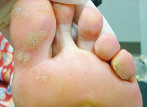 foot verruca best treatment